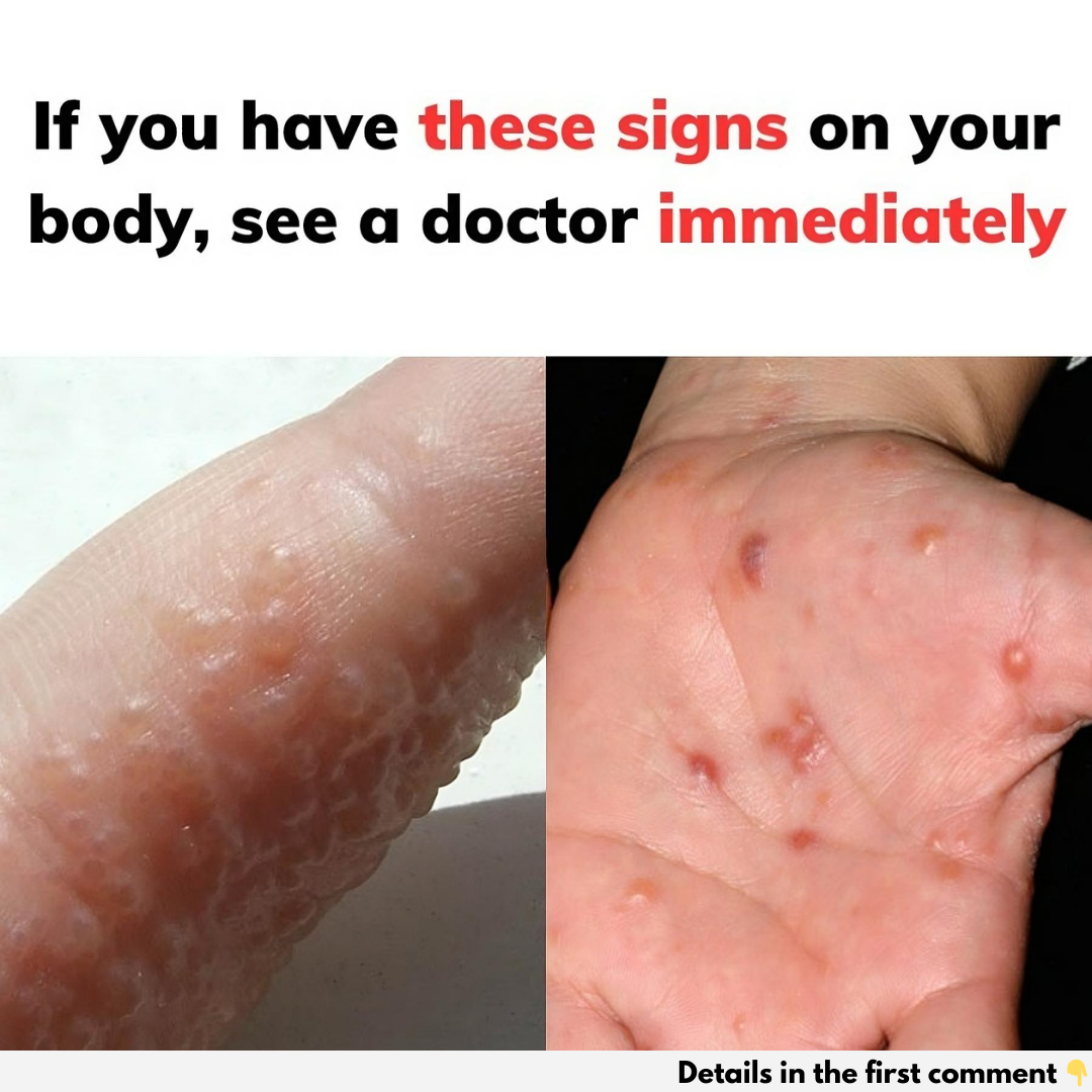 Dyshidrotic (Dyshidrosis) Eczema