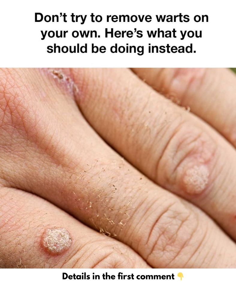 Don’t try to remove warts on your own. Here’s what you should be doing instead.