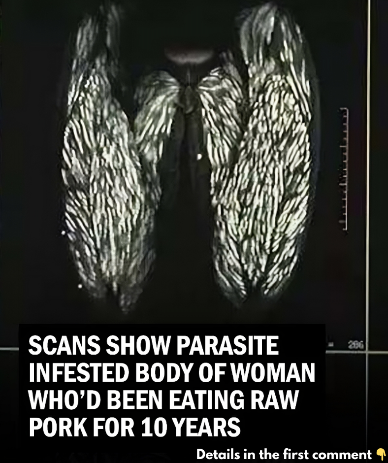 Scans Reveal Parasite-Infested Body of Woman Who Ate Large Amounts of Raw Pork for 10 Years