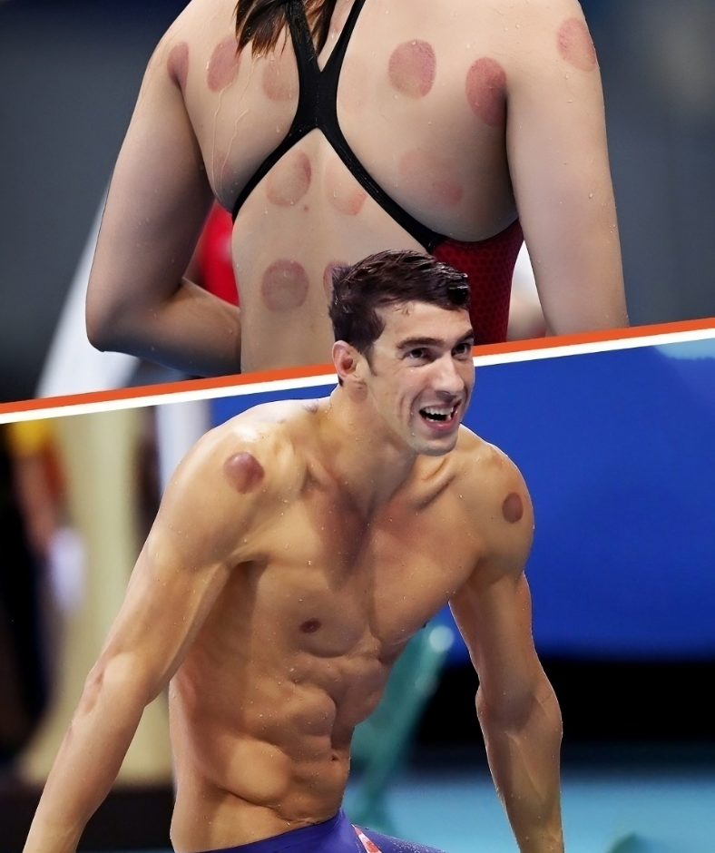 Why Were Olympic Athletes & Other Celebs Spotted with Dark Red Circles on Their Bodies?