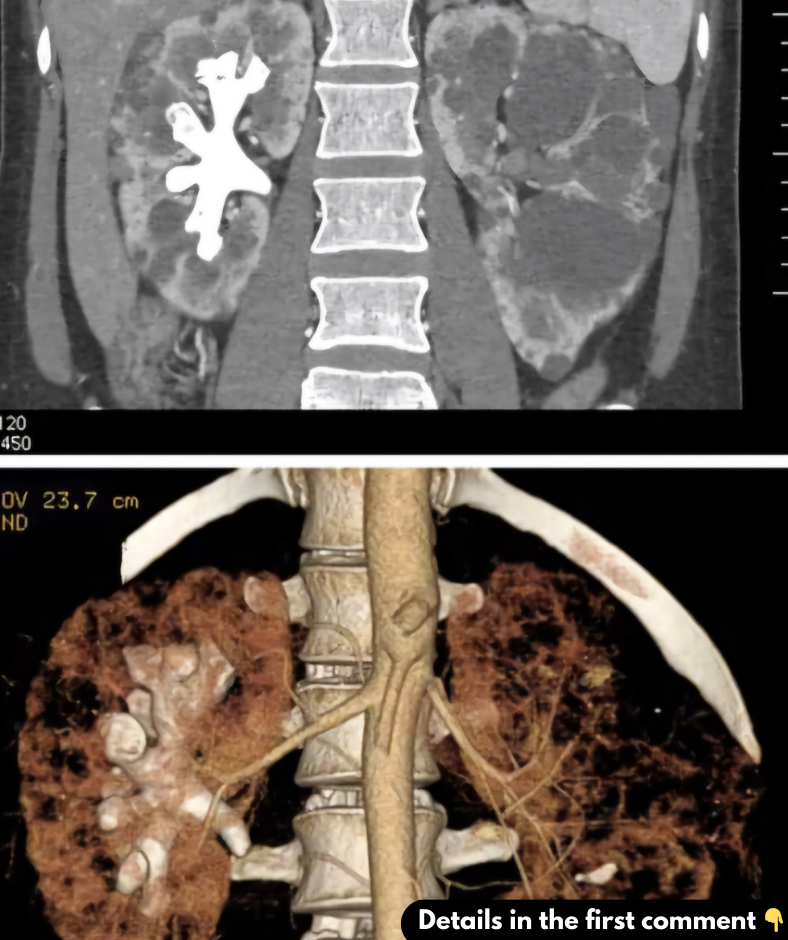 What Are Staghorn Kidney Stones? (Symptoms, Causes, and Treatment) 