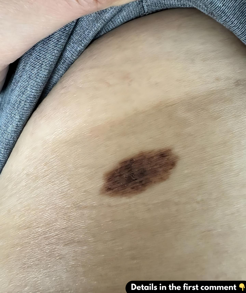 I have this mole that has patchy dark spots on it. What should I do?