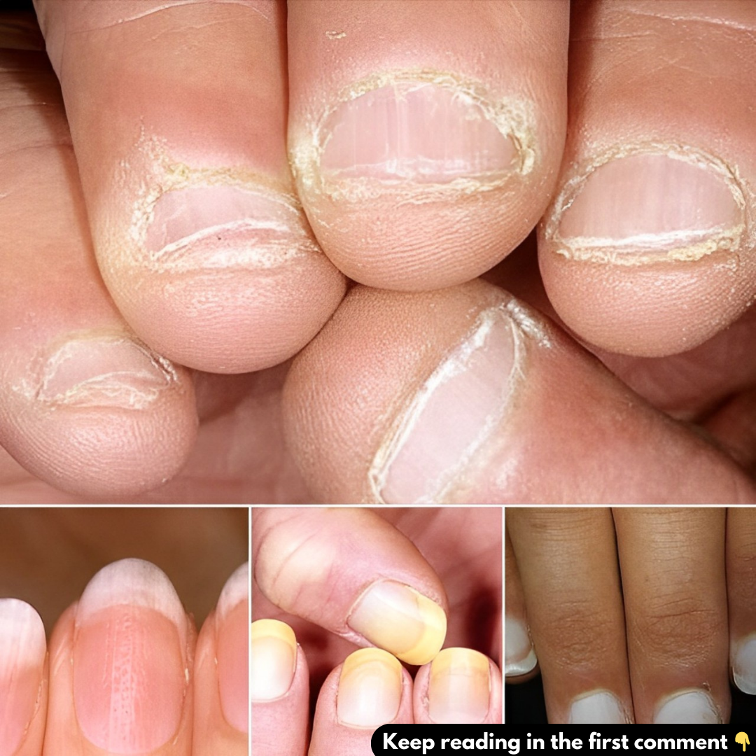 Doctor Reveals 7 Health Conditions You Can Spot By Just Checking Your Nails…