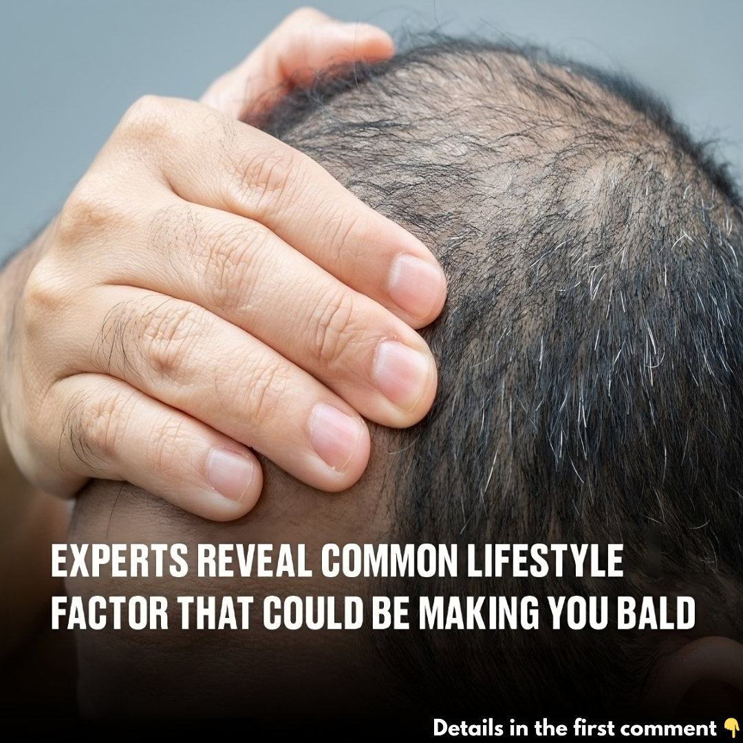 Experts reveal common lifestyle factor that could be making you bald