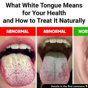 What White Tongue Means for Your Health and How to Treat It Naturally What White Tongue Means for Your Health and How to Treat It Naturally