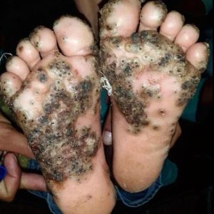 Tungiasis: The Silent Infection That Lurks in Your Feet…