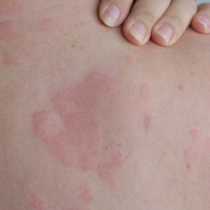 Got red, itchy welts on my back. Doctor’s appointment is weeks away. How to to calm it down