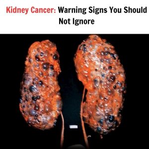 7 early warning signs that cancer is growing inside your kidneys