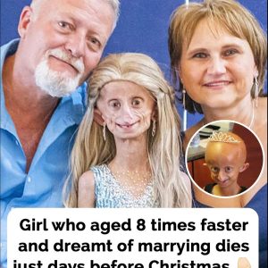 Beandri Booysen: Girl in South Africa with progeria d*es Beandri Booysen: Girl in South Africa with progeria d*es