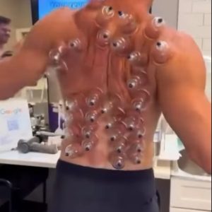 Have You Tried Cupping? Here’s What You Need to Know About the Ancient Practice… Have You Tried Cupping? Here’s What You Need to Know About the Ancient Practice…